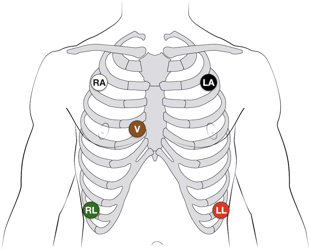 ecg electrode placements in the body