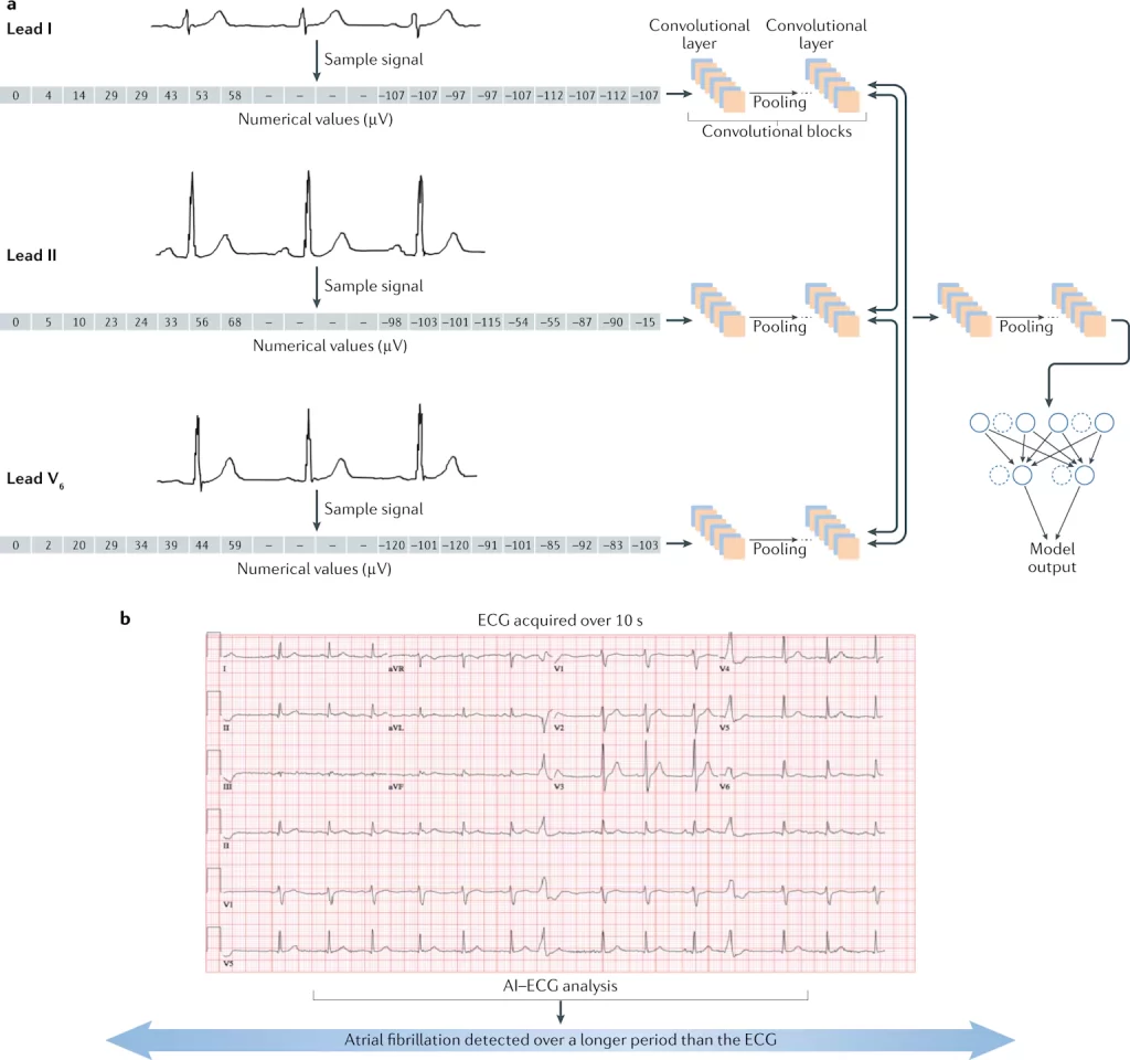 sample output of ecg machine with variaous lead sample signals