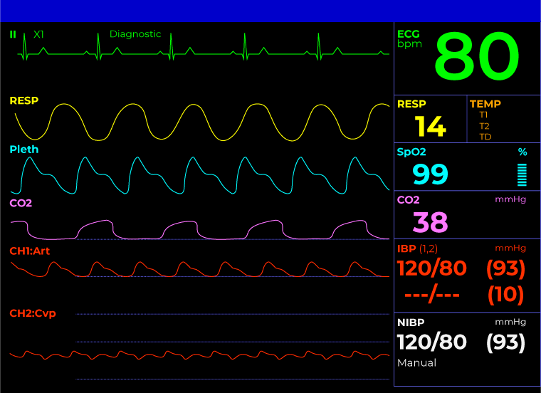 ecg monitor video in the multipara monitor